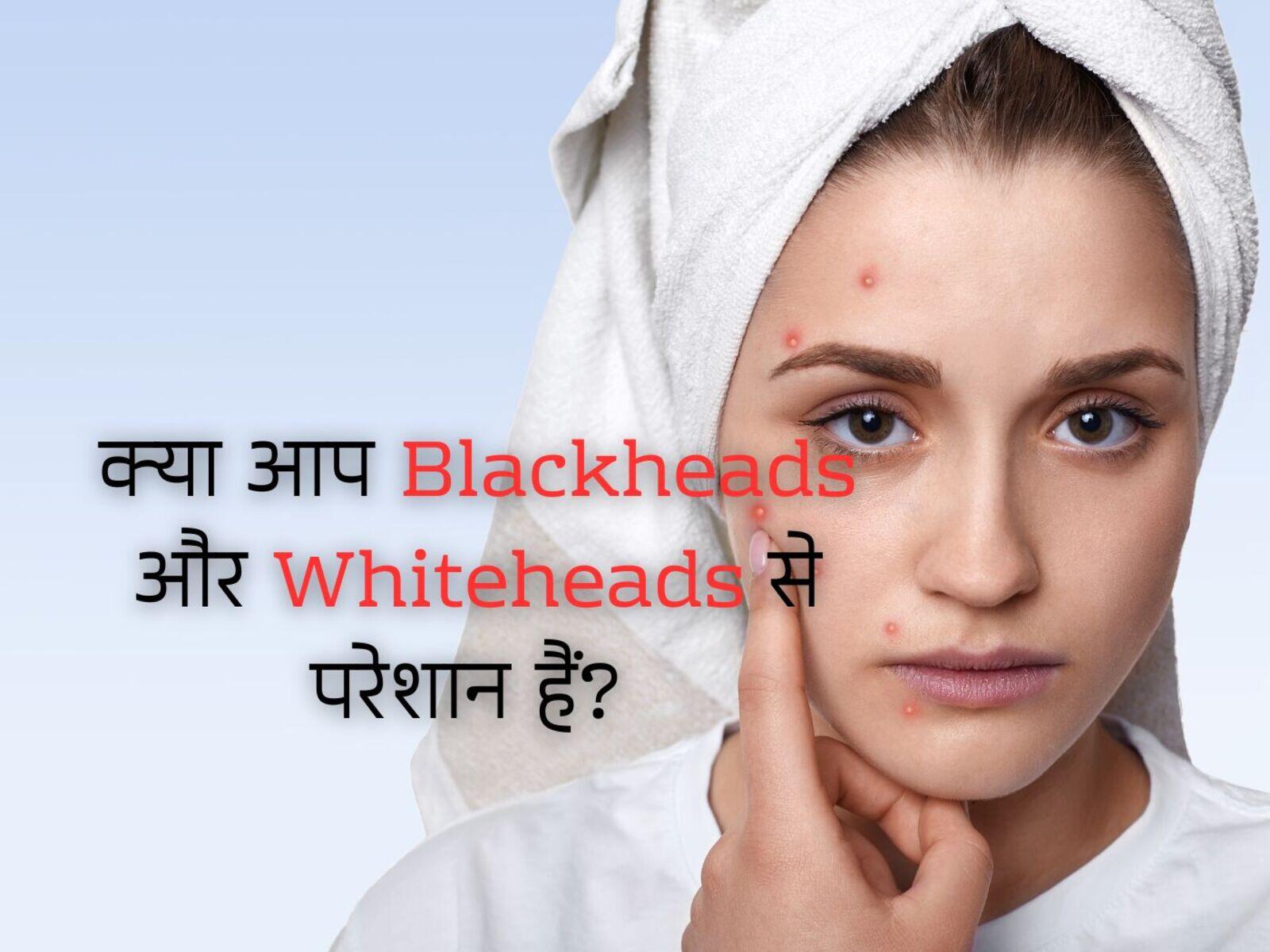क्या आप Blackheads और Whiteheads से परेशान हैं?